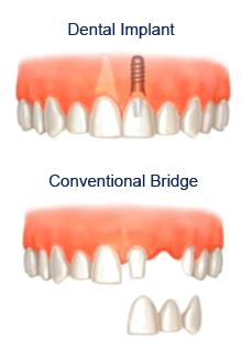 Dental Implants in Sheffield, tooth implant, flint, dental,  cosmetic dentistry Sheffield