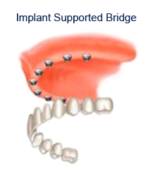 dental, implants, Sheffield, cosmetic, dentistry, dental, flint