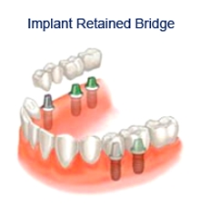 Dental Implants in Sheffield, tooth implant, flint, dental,  cosmetic dentistry Sheffield