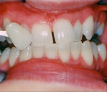 tooth whitening Sheffield, cosmetic dentistry Sheffield, whiter teeth, dentists in sheffield, 